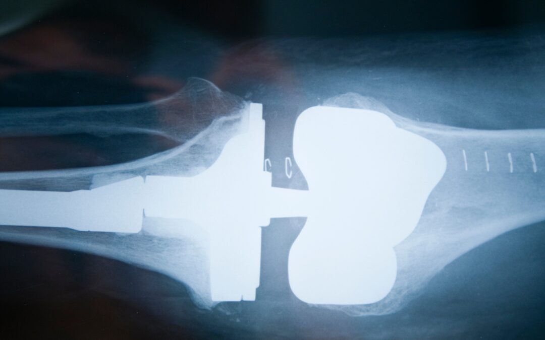 Prótesis en el codo (Artroplastia)